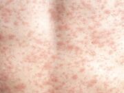 RFK Jr. necesita abogar ‘incondicionalmente’ por la vacuna contra el sarampión, la falta de vacunación causa muertes y brotes