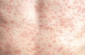 RFK Jr. necesita abogar ‘incondicionalmente’ por la vacuna contra el sarampión, la falta de vacunación causa muertes y brotes