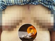 A un hombre de 76 años le crecen los senos después de tomar medicamentos comunes