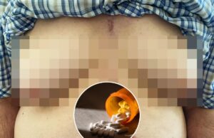 A un hombre de 76 años le crecen los senos después de tomar medicamentos comunes