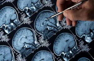 La retina periférica puede ayudar a detectar signos tempranos de Alzheimer antes de que se produzca daño cerebral