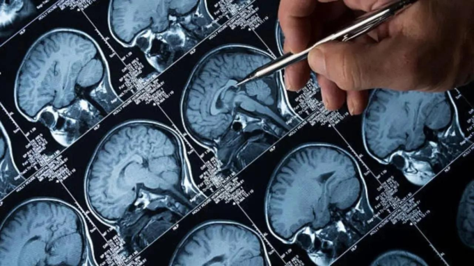 Los tumores cerebrales toman el control del metabolismo del azúcar para crecer: estudio