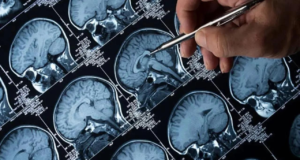 Médicos de Mumbai reviven la independencia de una mujer que padece la enfermedad de Parkinson