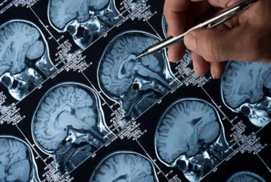 Doctores de Mumbai: más adultos mayores de 30 años padecen tumores cerebrales que personas mayores